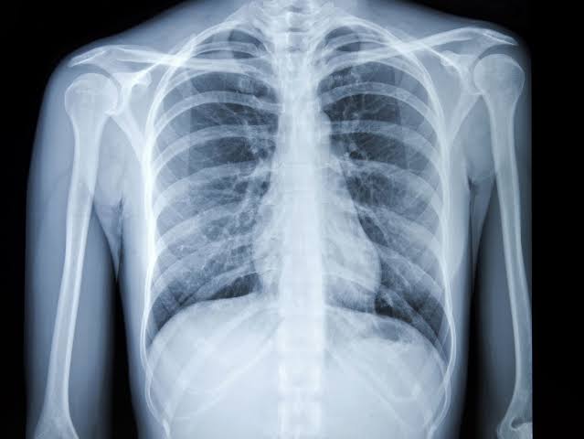 Chest X-Ray